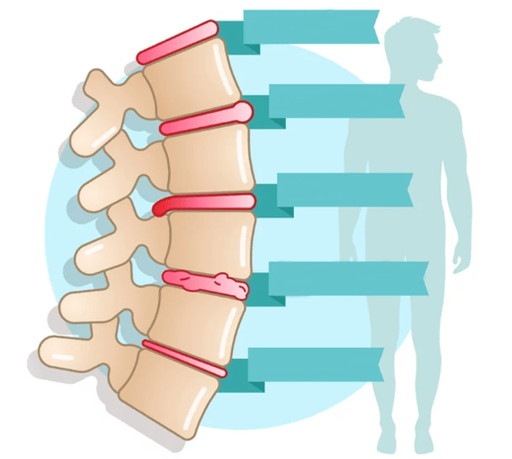 A mellkasi osteochondrosis betegségének mértéke