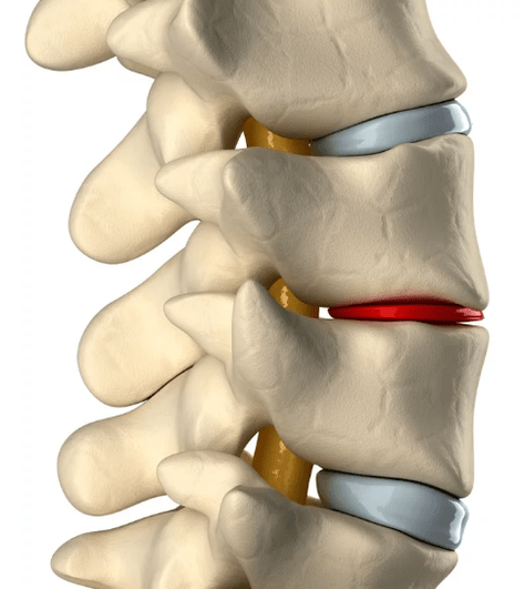 a mellkasi gerinc osteochondrosis