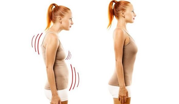 egyenes hát és rossz testtartás nyaki osteochondrosissal