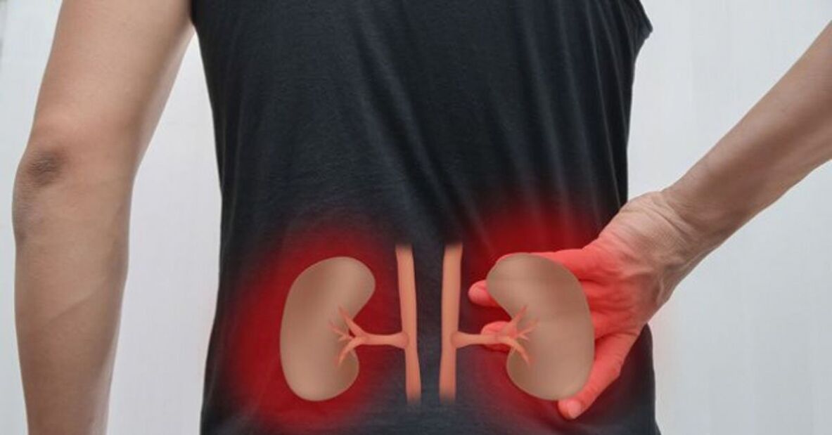 vesebetegség, mint a derékfájás oka