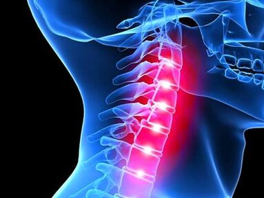 a nyaki gerinc osteochondrosisa