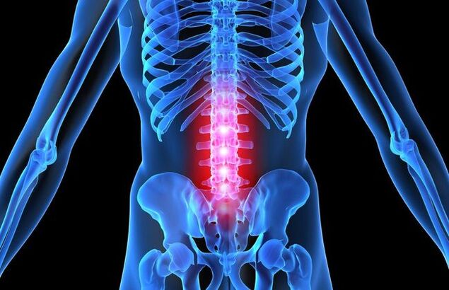 Az ágyéki gerinc osteochondrosisának előrehaladott stádiumában az ember motoros aktivitása romlik. 